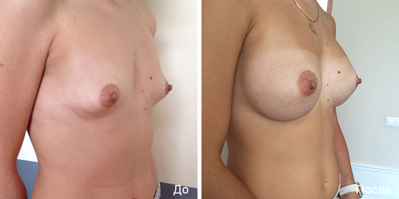 Пациентка Д. В. Крысина до и после маммопластики