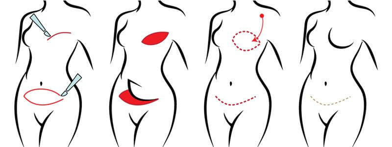 Фото: реконструкция груди с помощью технологии DIEP-флап