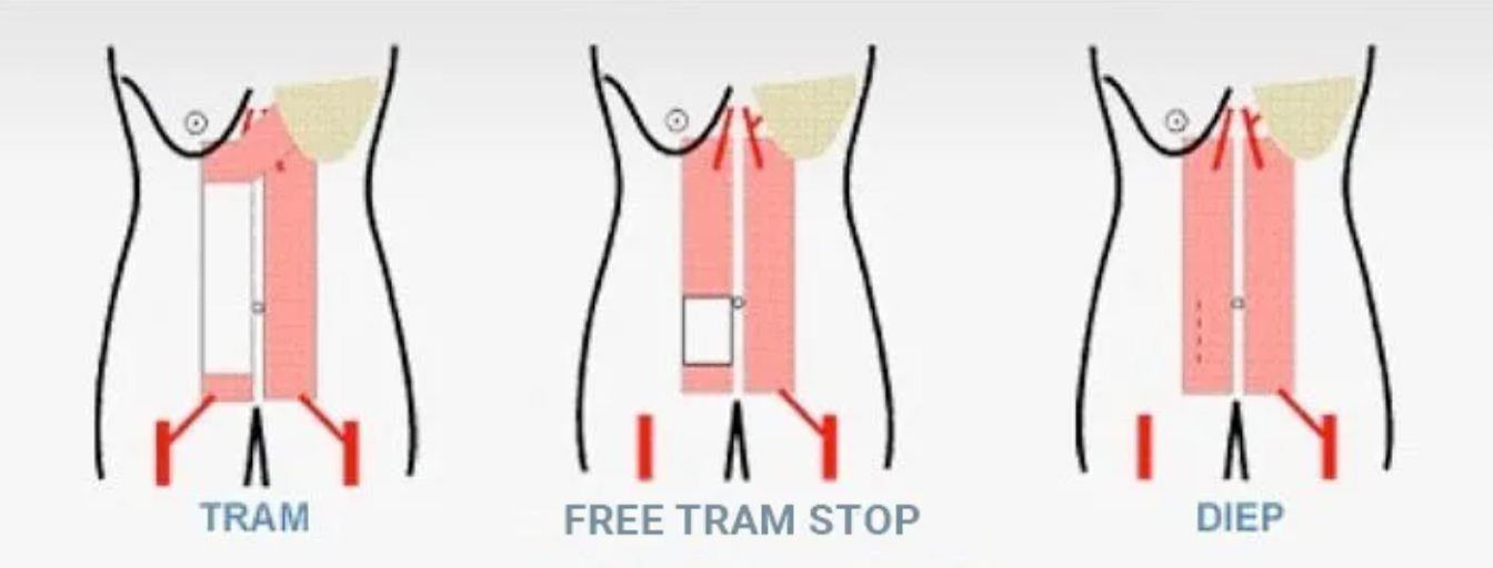 Фото: реконструкция груди с помощью технологии DIEP-флап