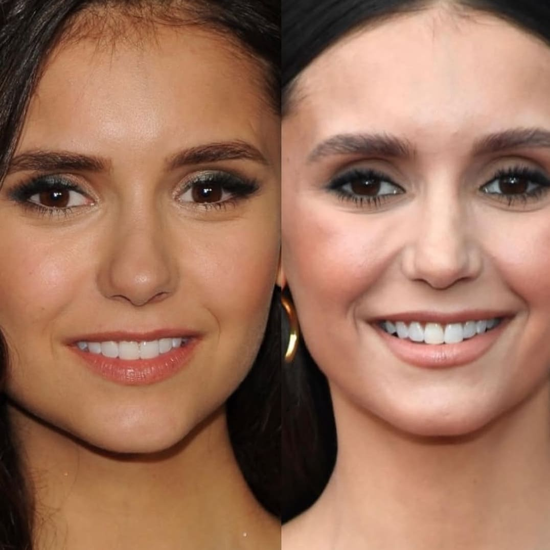 Нина Добрев до и после пластики