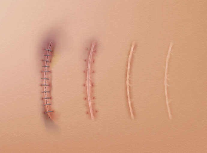 Рубцы после пластики