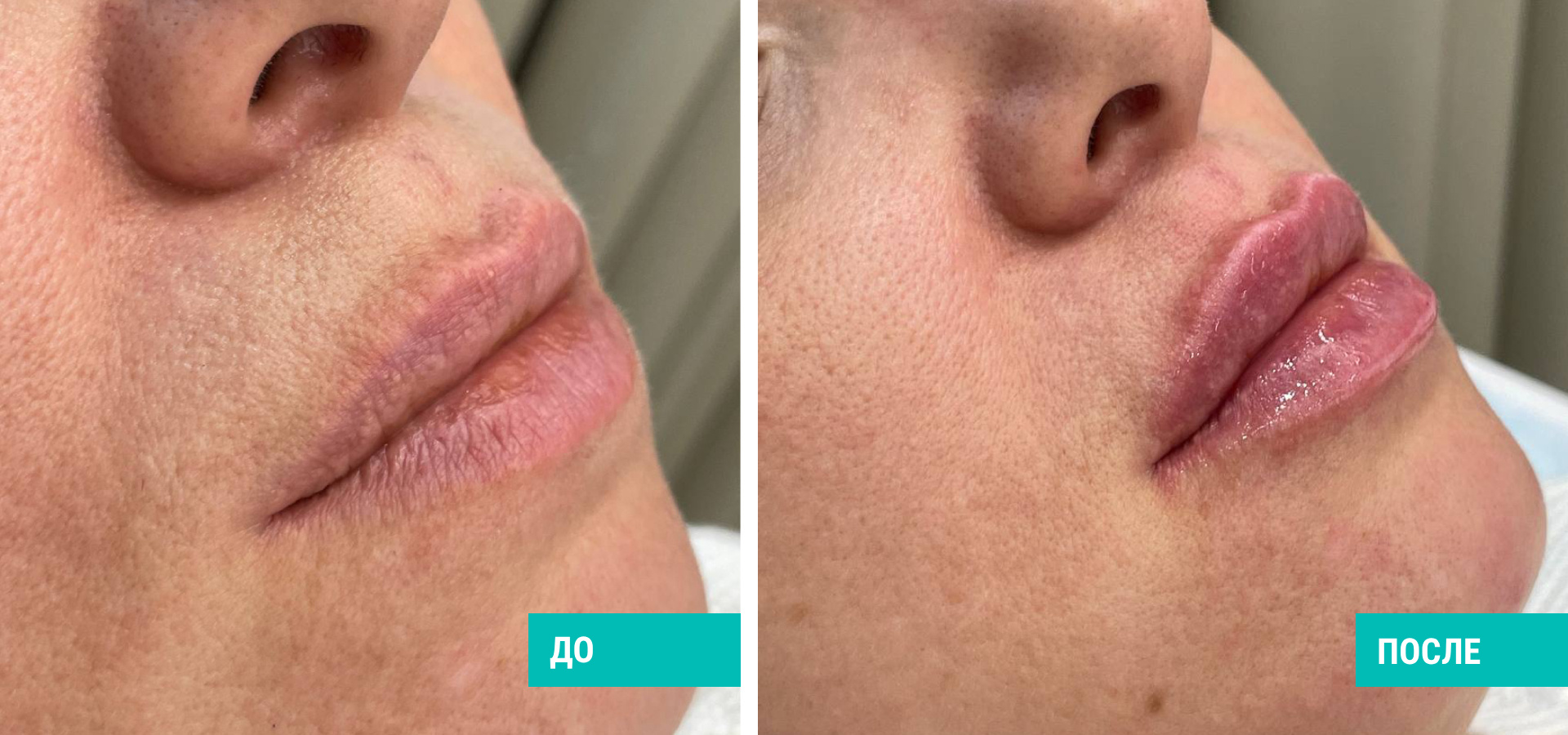 До и после контурной пастики губ. Пациентка Д. О. Аёзова