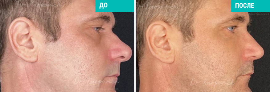 Ринопластика