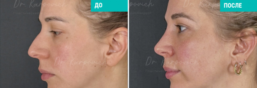 Ринопластика