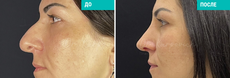 Ринопластика