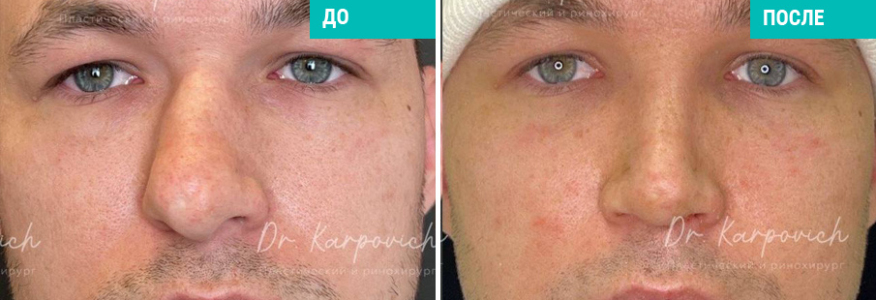 Ринопластика