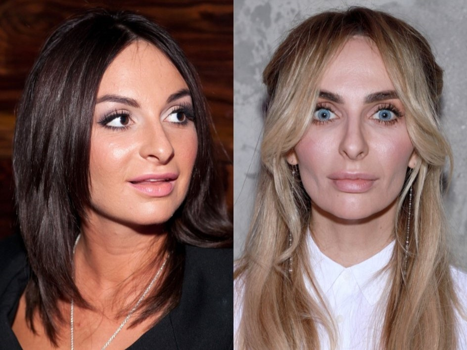 Екатерина Варнава до и после увеличения губ