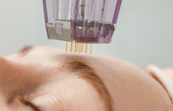 Золотая игла: современный подход к омоложению кожи