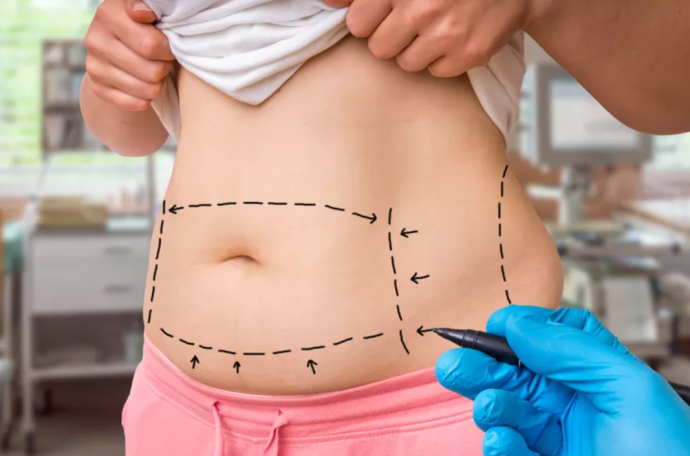 Возвращается ли жир после липосакции