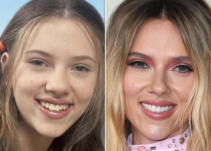 Скарлетт Йоханссон до и после пластики