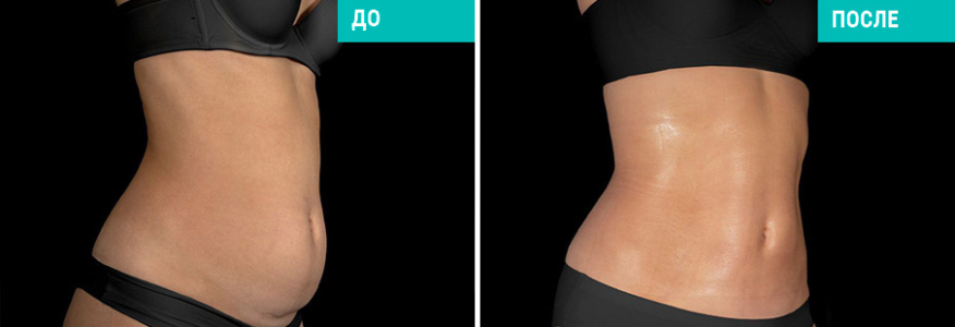 Миниабдоминопластика