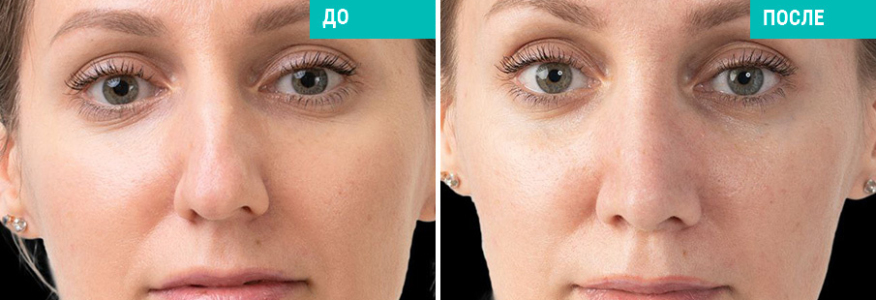 Ринопластика