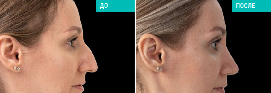 Ринопластика