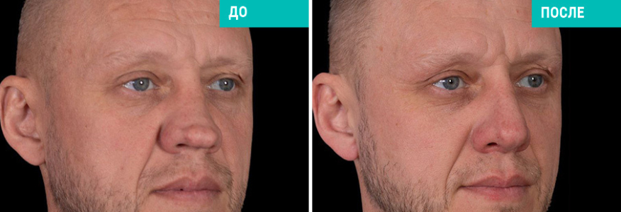 Ринопластика