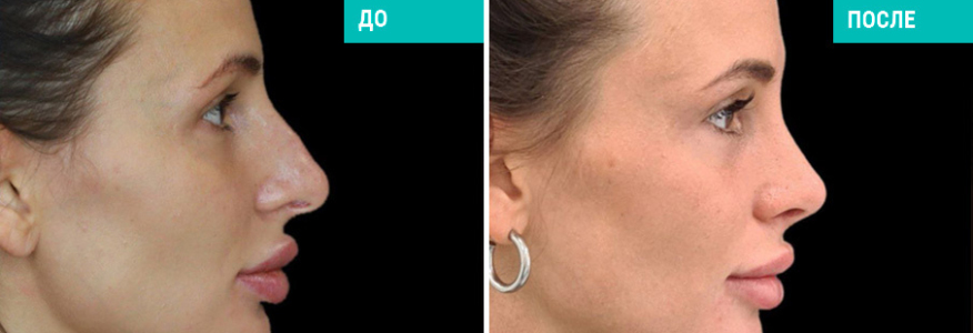 Ринопластика