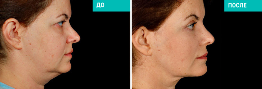 Омоложение лица