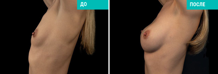 Маммопластика