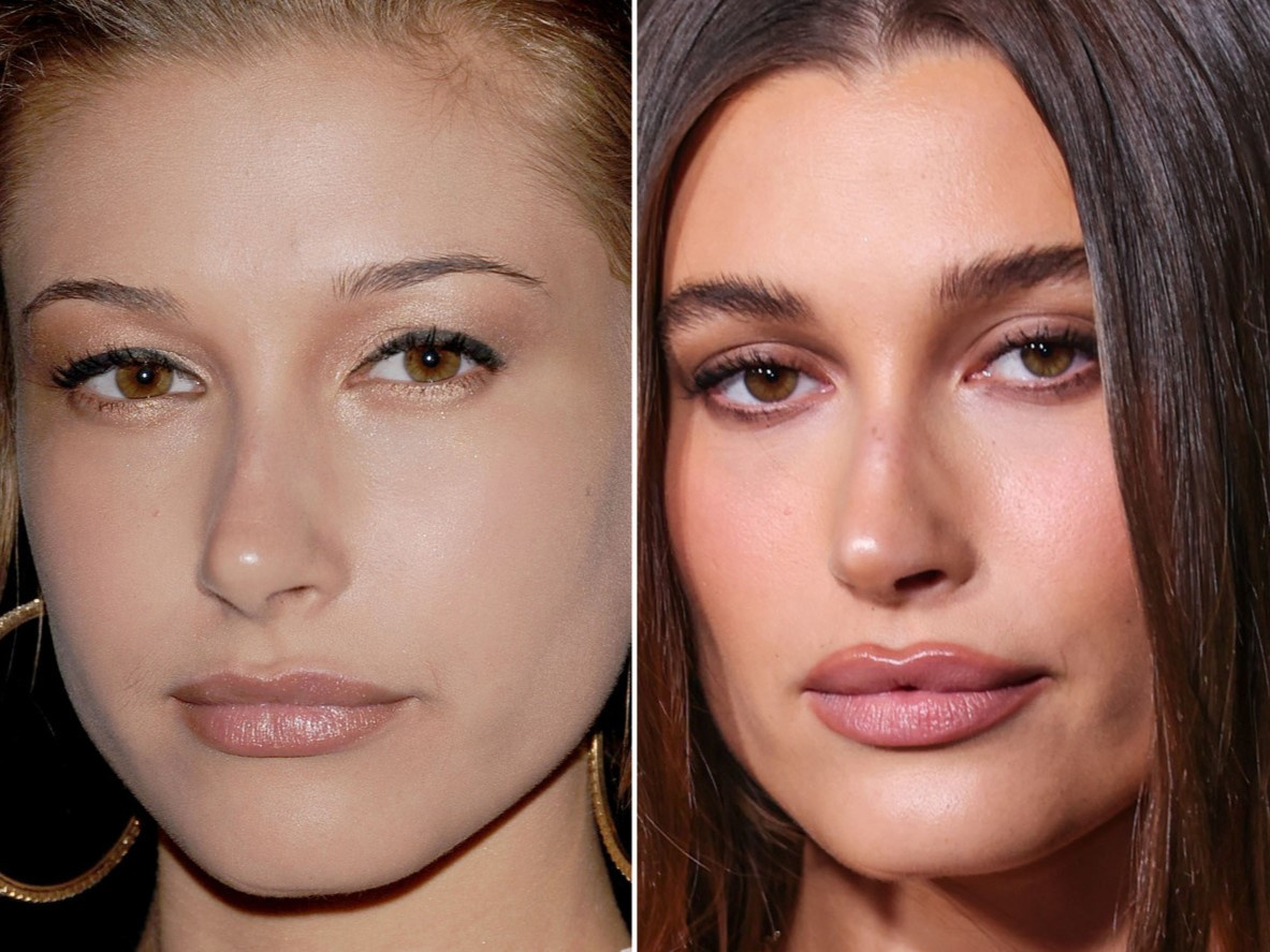 Хейли Бибер до и после увеличения губ