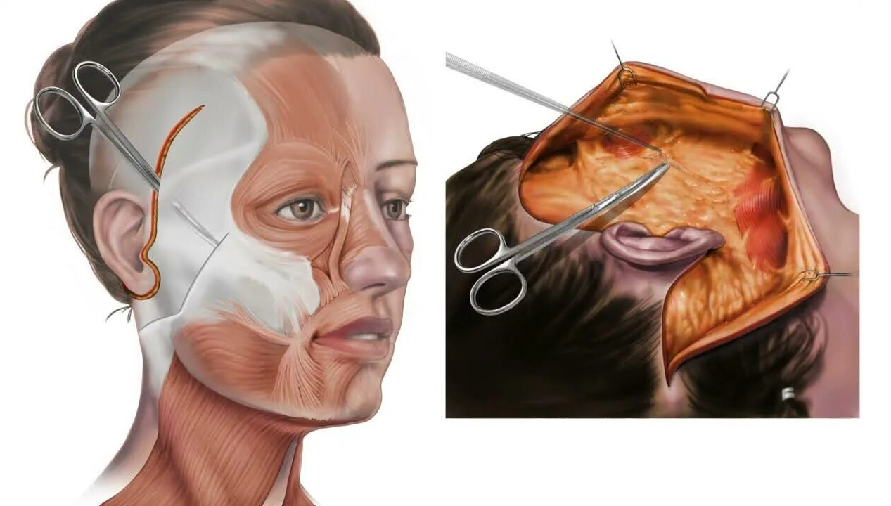 Фото: подтяжка лица методом Deep Plane