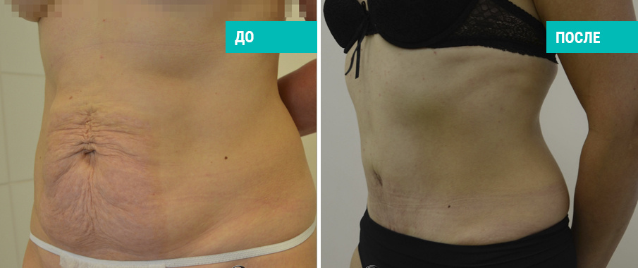 До и после абдоминопластики. Пластический хирург Ованесова О. А.