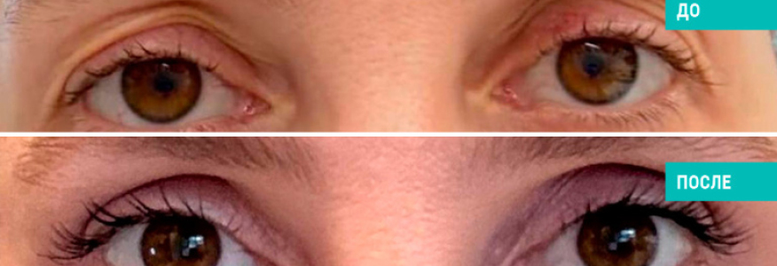 Верхняя блефаропластика