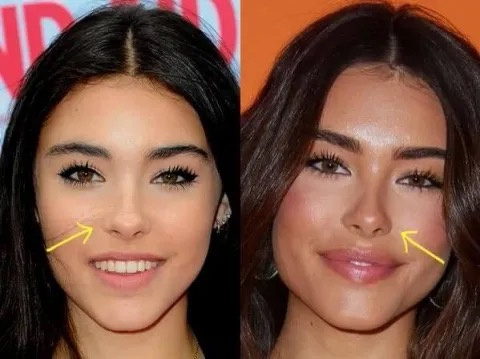 Фото: Мэдисон Бир до и после пластики