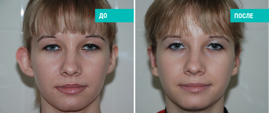 Отопластика: до и после. Хирург: А.А.Михайлов