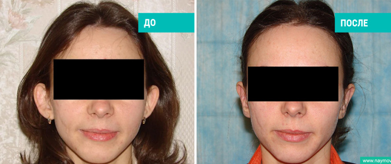 Отопластика: до и после. Хирург: В.В. Наумов