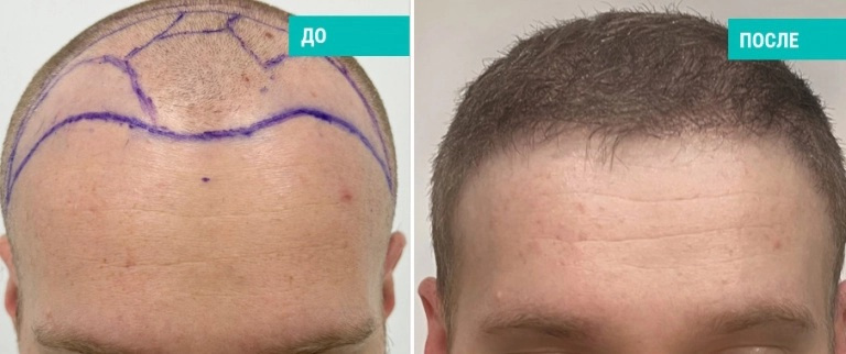 Пересадка волос. Пластический хирург: Тебуева А.Д.