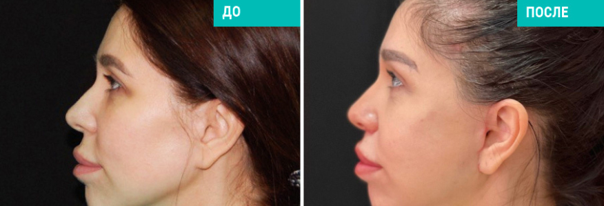 Подтяжка лица