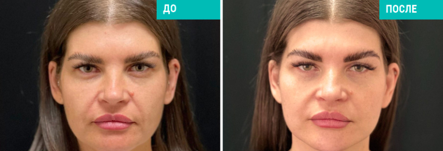 Подтяжка лица