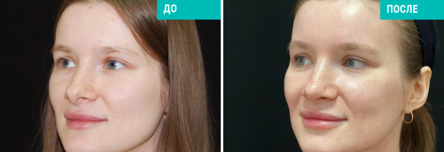 Ринопластика