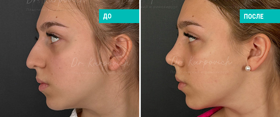 До и после ринопластики. Пластический хирург С. М. Карпович