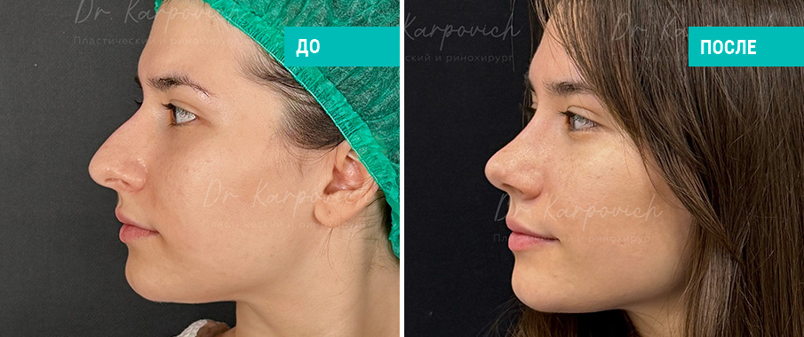 До и после ринопластики. Пластический хирург С. М. Карпович