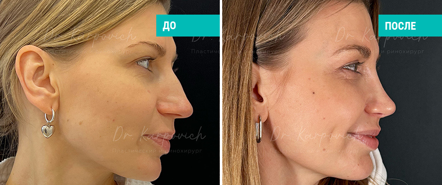 До и после ринопластики. Пластический хирург С. М. Карпович