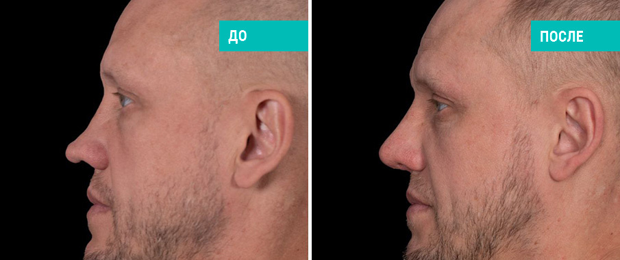 До и после ринопластики. Пластический хирург Д. В. Пахилин