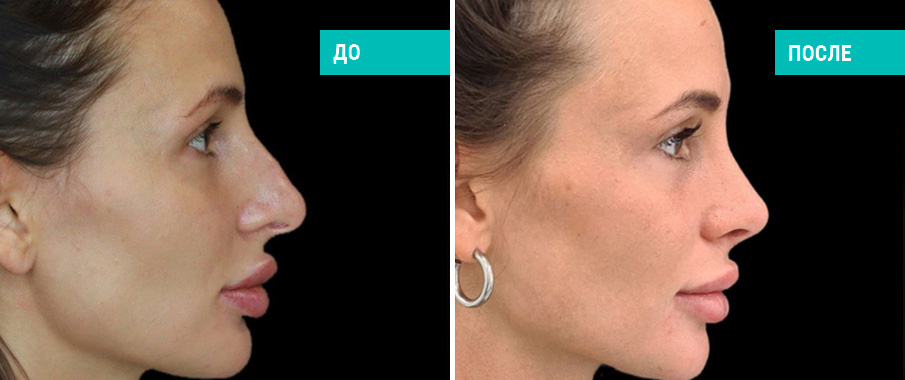 До и после ринопластики. Хирург Д. В. Пахилин