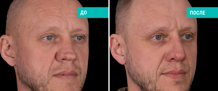 До и после ринопластики. Хирург С. М. Карпович