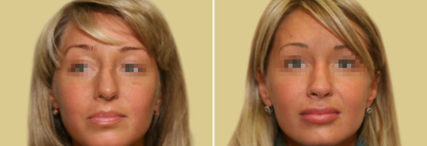 Ринопластика 