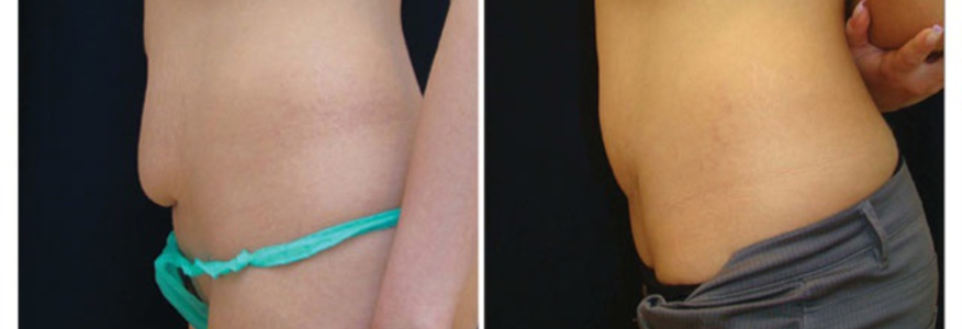 Абдоминопластика