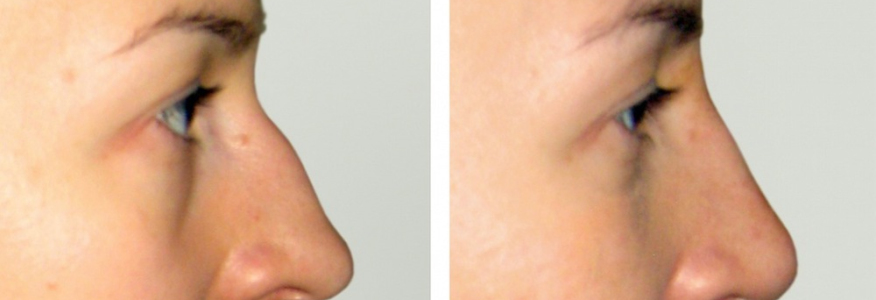 Ринопластика 