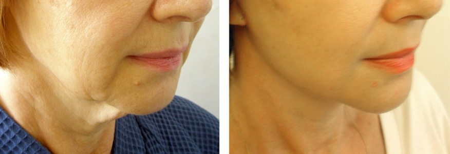 Фейслифтинг