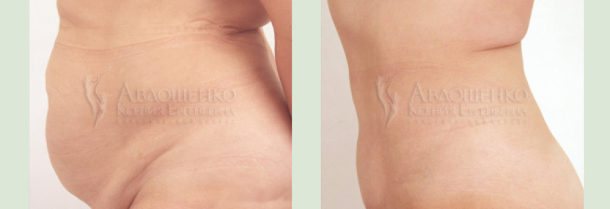 Абдоминопластика