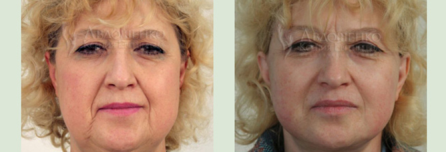 Фейслифтинг