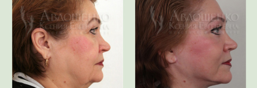 Фейслифтинг