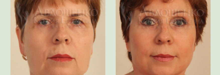 Фейслифтинг