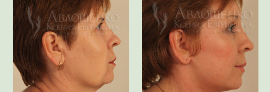 Фейслифтинг