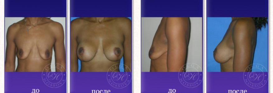 Увеличение груди