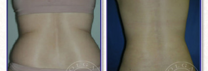 Липосакция