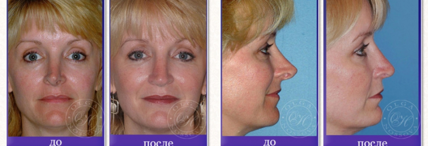 Ринопластика